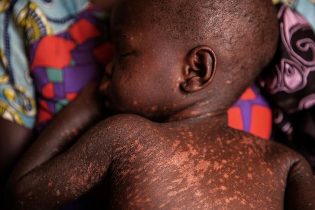 Bor hospital records six cases of measles with one death