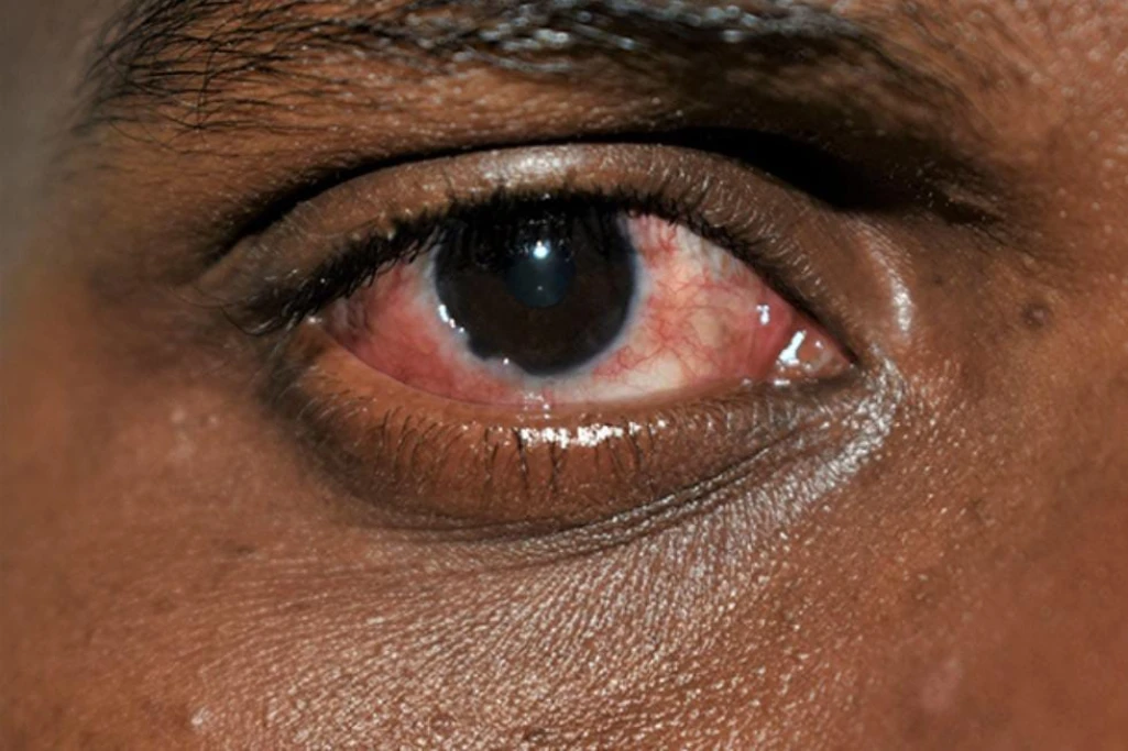 MoH issues alert on red eye disease