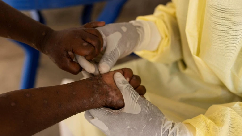 Ethiopia reports first mpox case